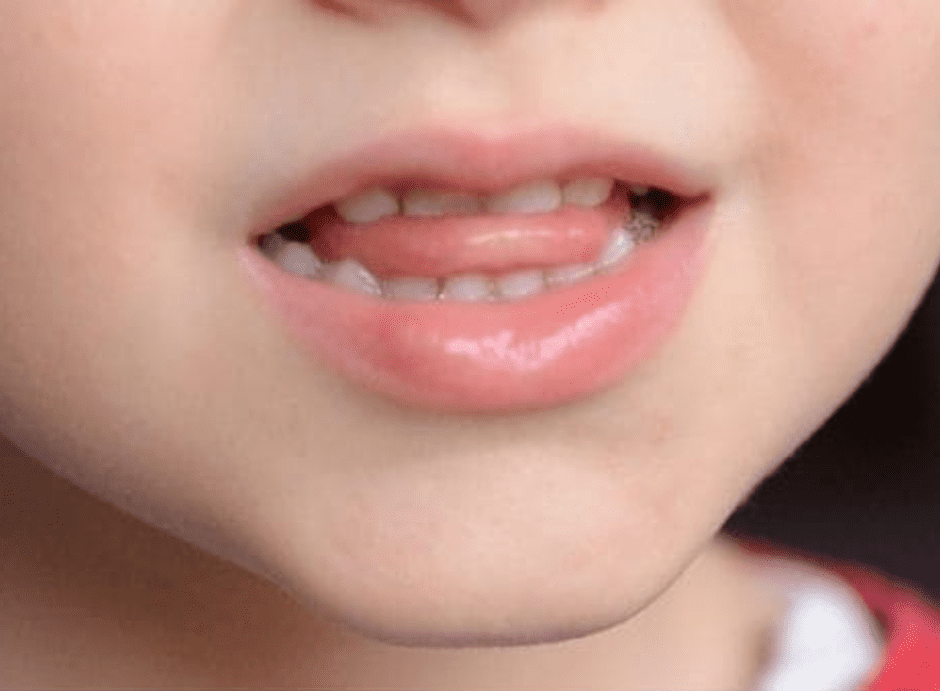 Blogartikel: Lispeln loswerden - Tipps und Übungen für Kinder und Erwachsene